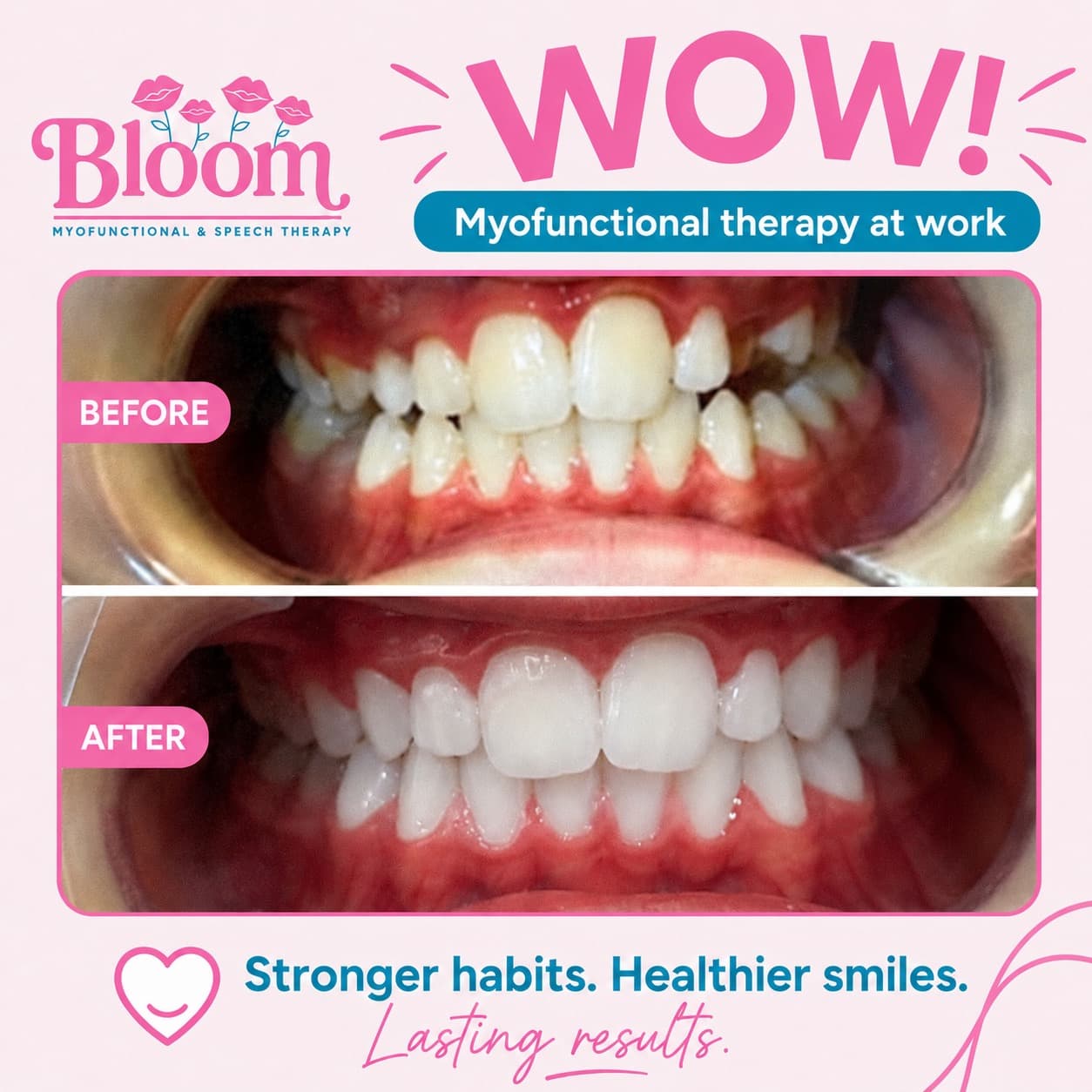 Before and after results of orofacial myofunctional therapy — improved tooth alignment and bite at Bloom
