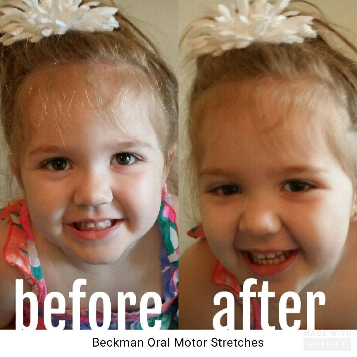 Before and after results of Beckman Oral Motor Stretches showing improved oral motor function in a child